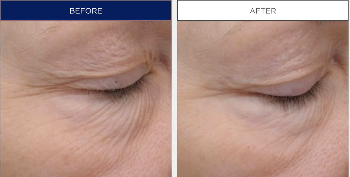 NEOSTRATA "Skin Active" Intensive Eye Therapy 15g