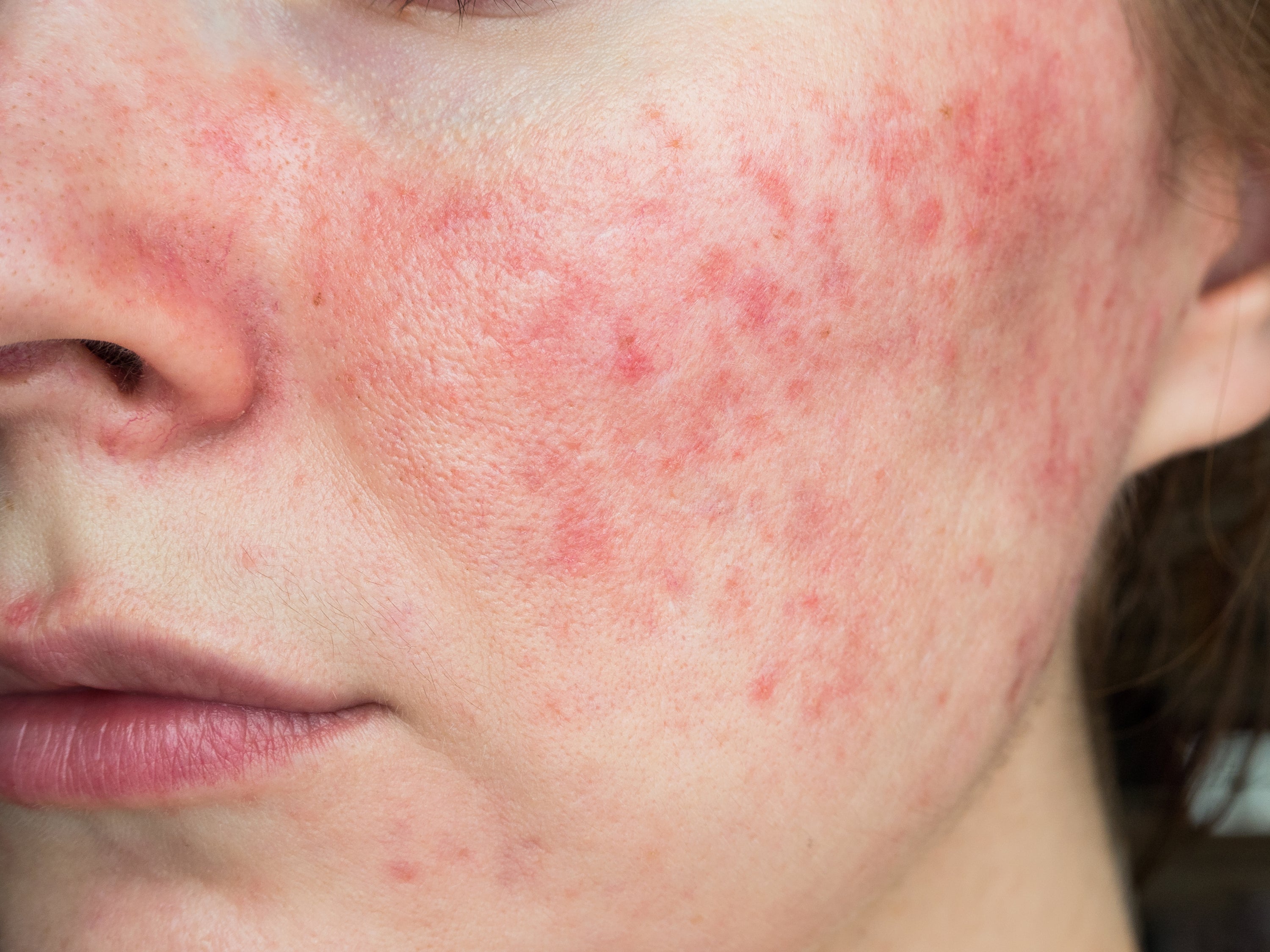 Rosacea Triggers