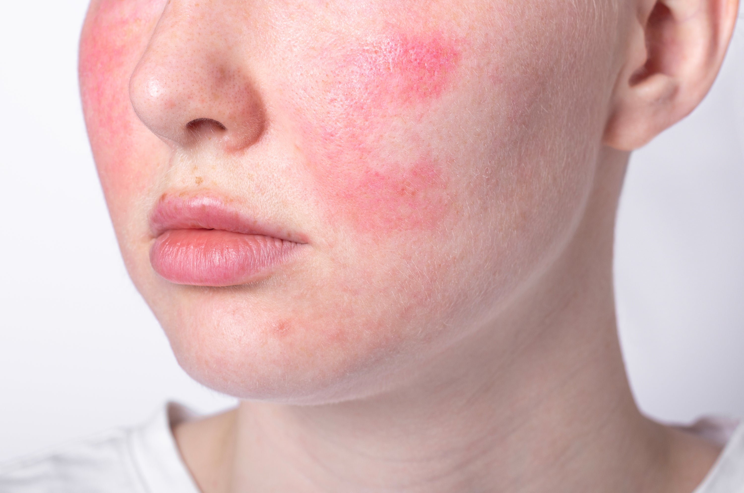 April is Rosacea Awareness Month