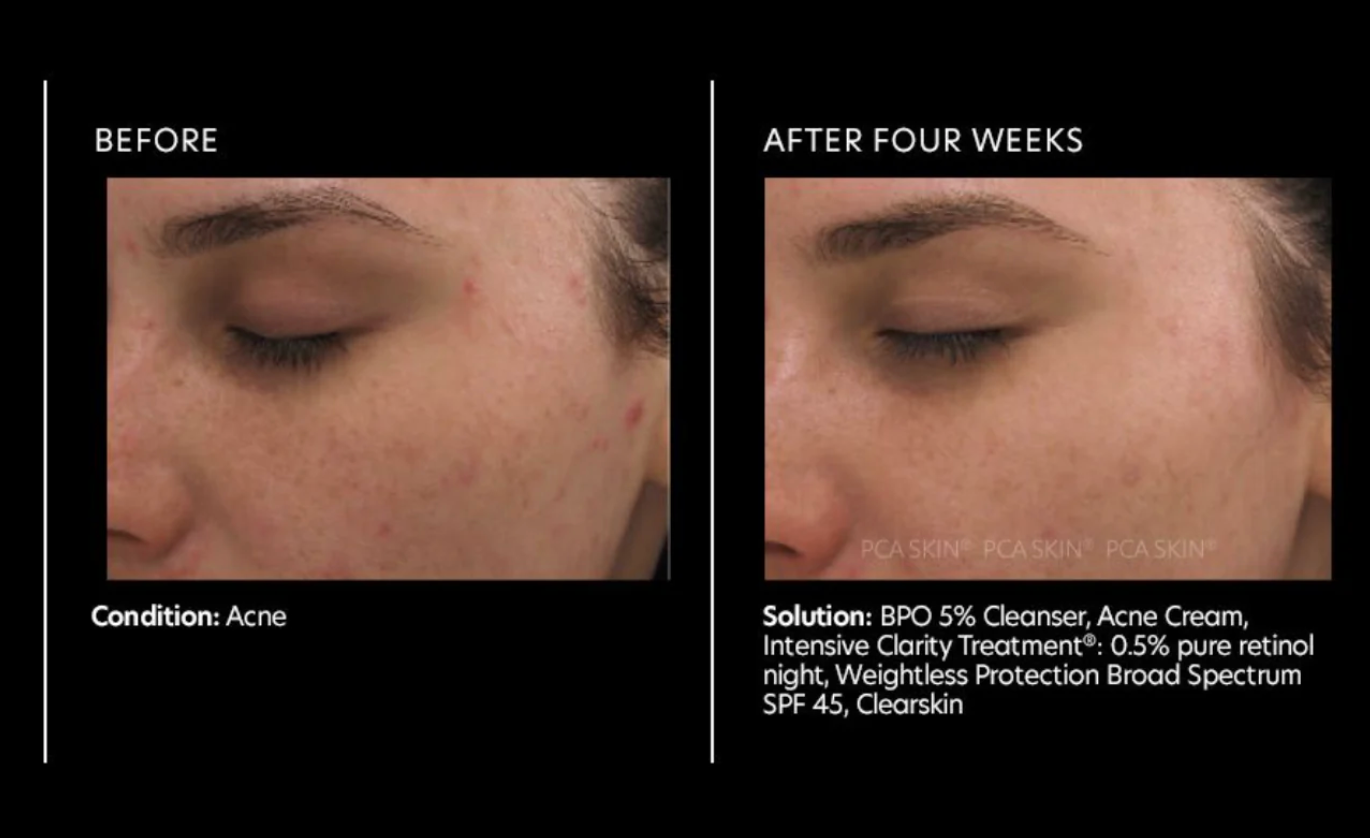 PCA SKIN Intensive Clarity Treatment®: 0.5% pure retinol night 29.5g